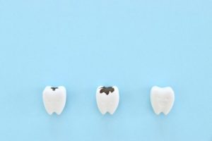 矯正治療中に虫歯ができたらどうなりますか?